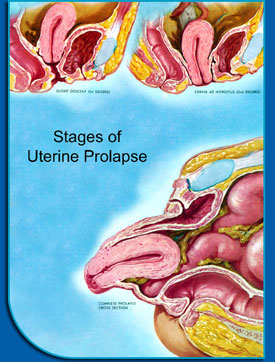 stages of uterine prolapse