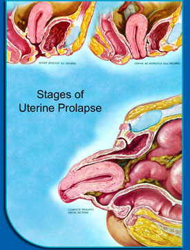 Pelvic Organ Prolapse