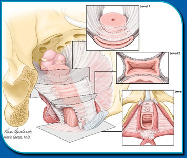 abdominal reconstruction